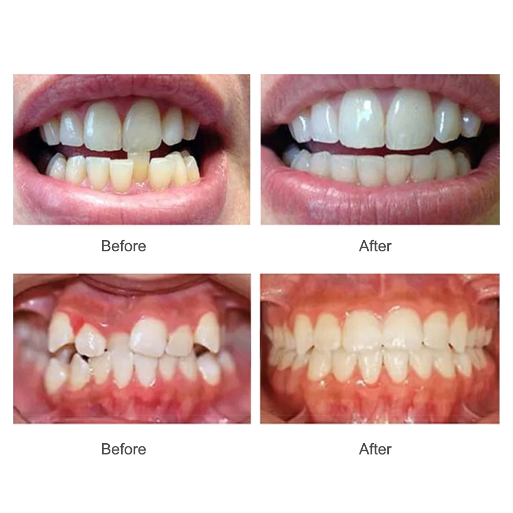 Orthodontic Braces Dental Braces Smile Teeth Alignment Trainer Instanted Silicone Teeth Retainer Mouth Guard Braces Tooth Tray thumbnail 2