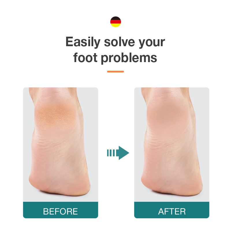 MR.GREEN Foot File Double Sided Callus Remover For Dead Skin Professional Pedicure Tools Callous Scraper Foot Sander Heel Filer thumbnail 2