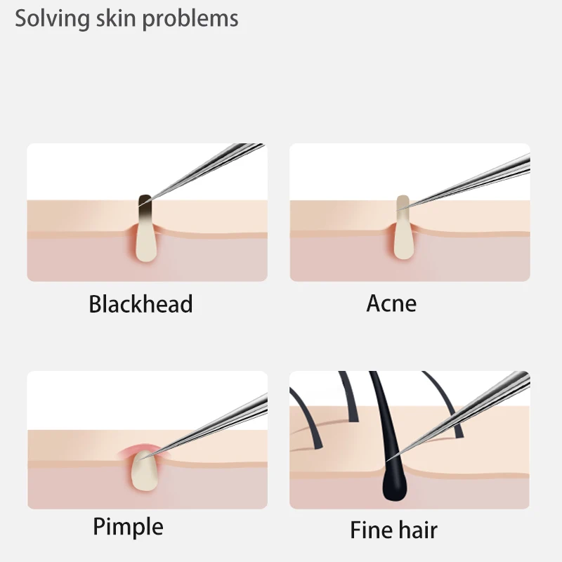 Acne Blackhead Removal Needles Stainless Steel Black Spot Blemish Pimple Removal Needle Deep Cleansing Tool Face Skin Care Kit thumbnail 5