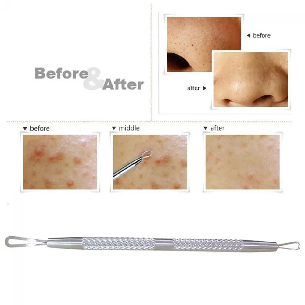 Professional Stainless Steel Blackhead Remover Tool Comedone Acne Pimple 2 Loop Needles Blemish Extractor Remover Skin Care Tool thumbnail 4