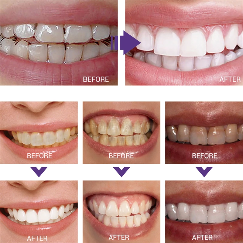 1pcs Teeth Cleansing Whitening Toothpaste Whiten Gel Whitener Bleach Removes Stains Fresh Breath Tooth Cleaning Korea Products thumbnail 2