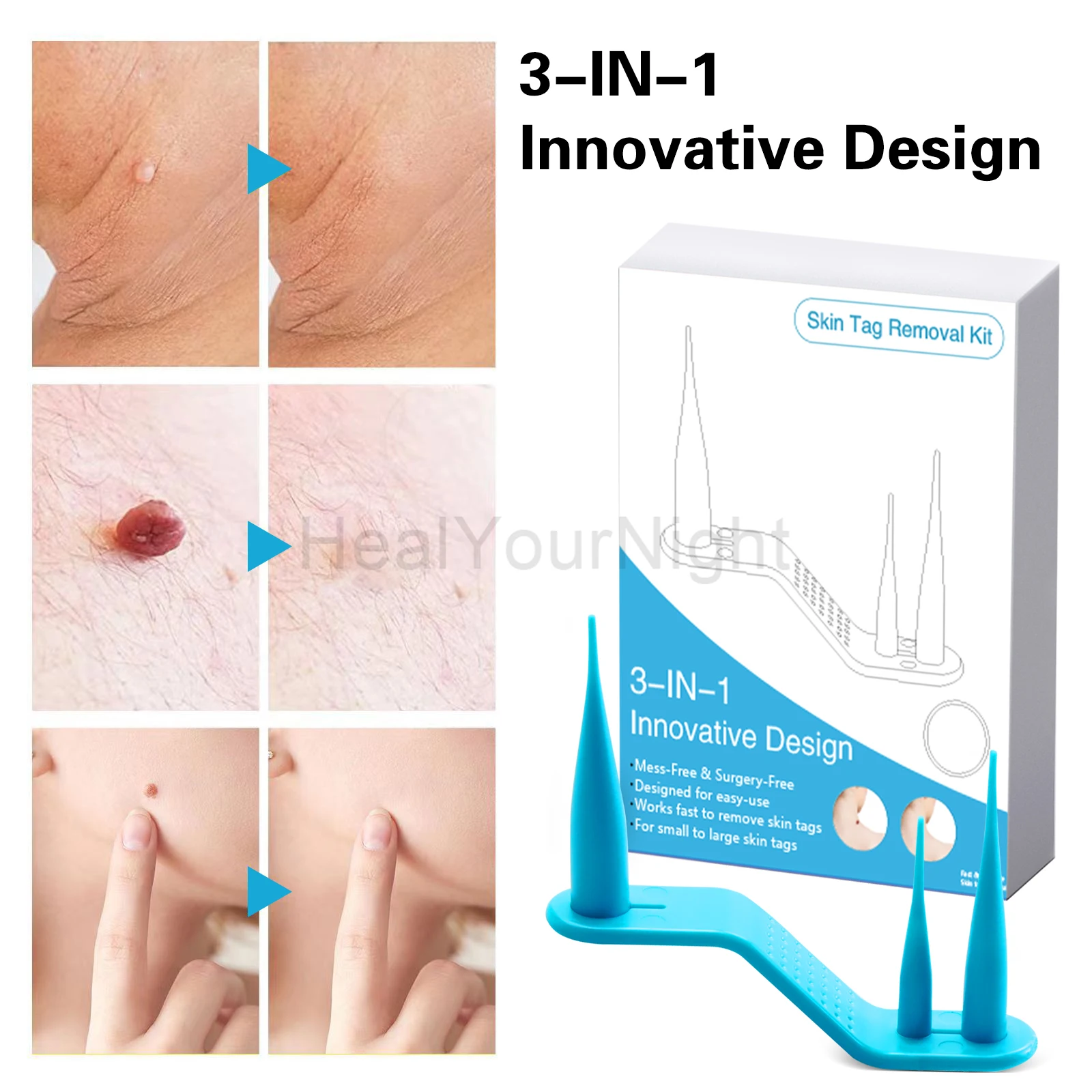 3-IN-1 Auto Skin Tag Removal Kit Painless Skin Label Mole Acne Wart Removal Pen Set with Cleansing Swabs Facial Beauty Care Tool thumbnail 4