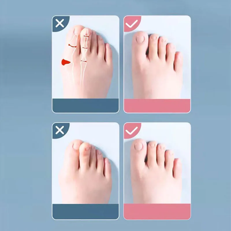 2Pc Silicone Toe Separator Fingers Feet Toe Spreader Hallux Valgus Bunion Corrector Toe Straightener Corrector Finger Separators thumbnail 3