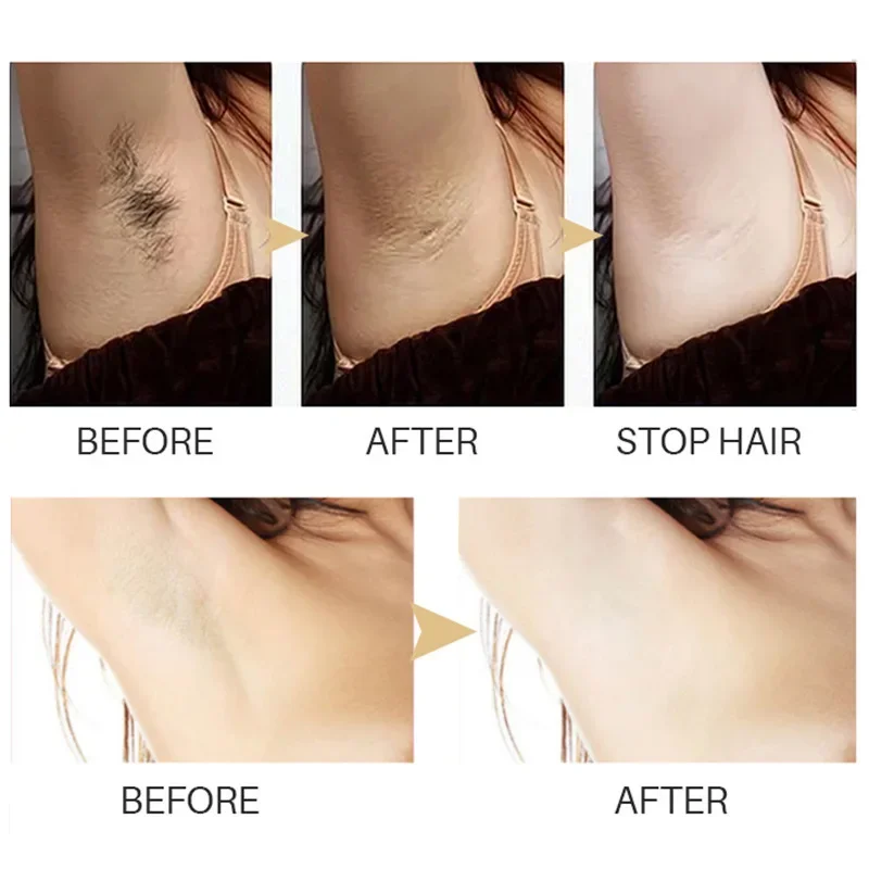 Permanent Hair inhibition Serum Painless Hair Remover Armpit Legs Arms Hair Growth Inhibitor Beauty Skin Care Body Essential Oil thumbnail 4