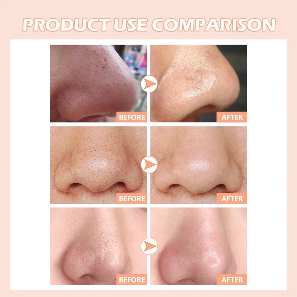 Blackhead Remover Pimple Popper Tool Acne Needle Removing Treatment Comedone Whitehead Popping Zit Nose Face Blemish Extractor thumbnail 5