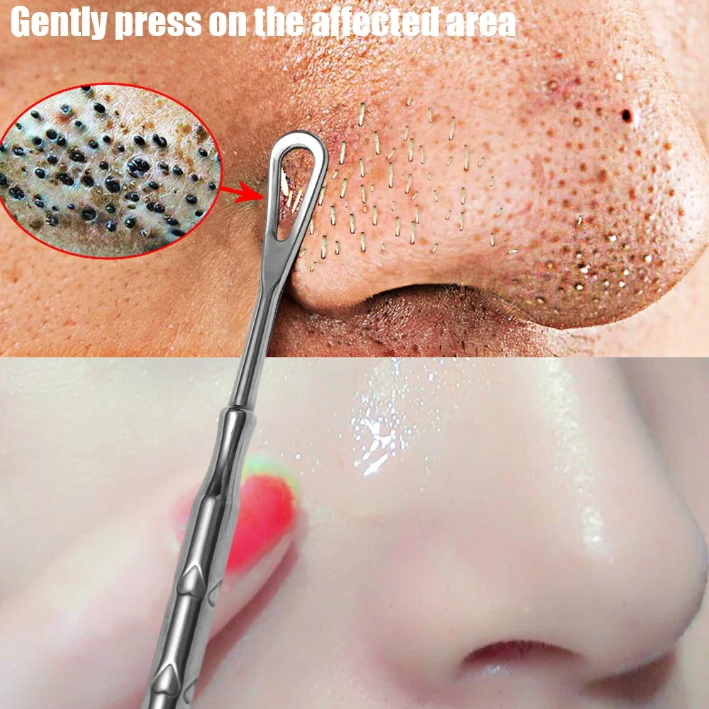 Blackhead Remover Pimple Popper Tool Acne Needle Removing Treatment Comedone Whitehead Popping Zit Nose Face Blemish Extractor thumbnail 4