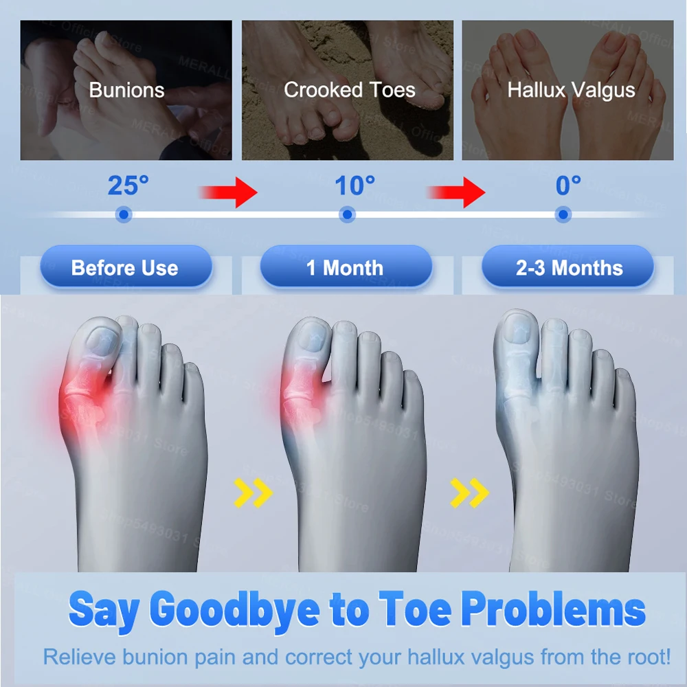 Adjustable Bunion Corrector Toe Separator Hallux Valgus Relief Toe Corrector Straightener Finger Correction Orthopedic Pedicure thumbnail 4