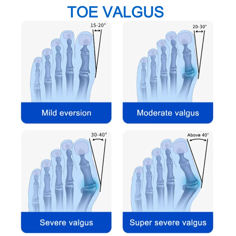 Bunion Splint Big Toe Straightener Hallux Valgus Correction Orthotics Foot Bone Thumb Adjuster Correction Bunions Corrector thumbnail 2