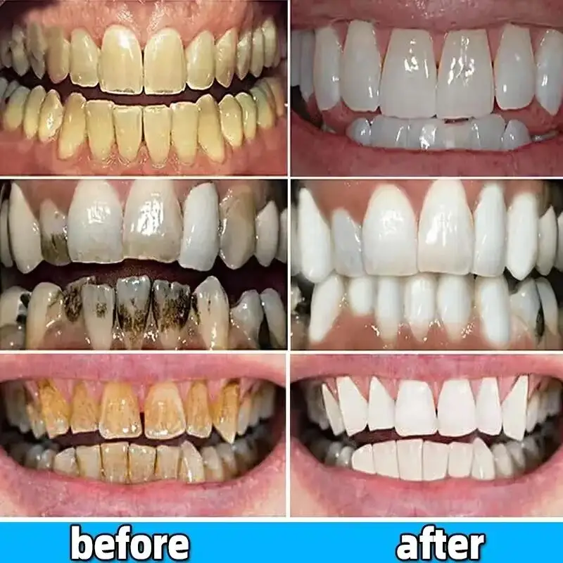 Dental Calculus Remover Teeth Whitening Spray Toothpaste Cleaning Oral Hygiene Removal Halitosis Plaque Stains Fresh Breath Care thumbnail 5