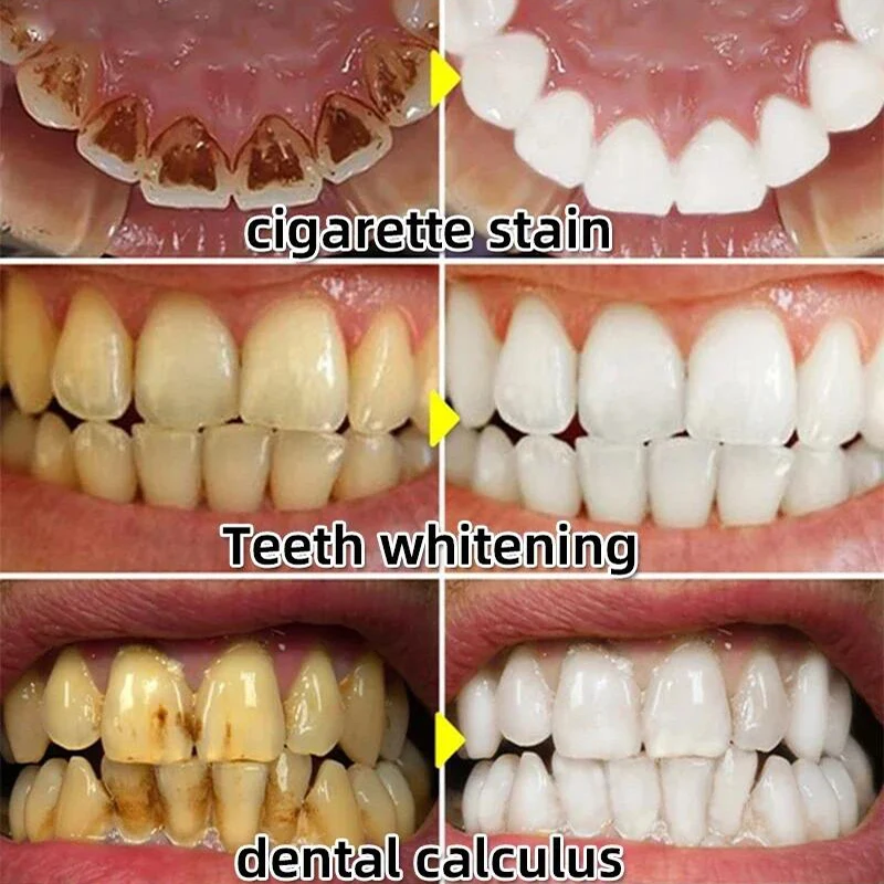 Dental Calculus Remover Teeth Whitening Spray Toothpaste Cleaning Oral Hygiene Removal Halitosis Plaque Stains Fresh Breath Care thumbnail 3