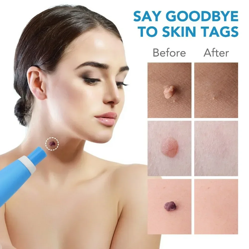 2 In1 Painless Auto Skin Tag Mole Wart Removal Kit Cleaning Tools Face Skin Care Body Wart Dot Treatments Remover Beauty Health thumbnail 4