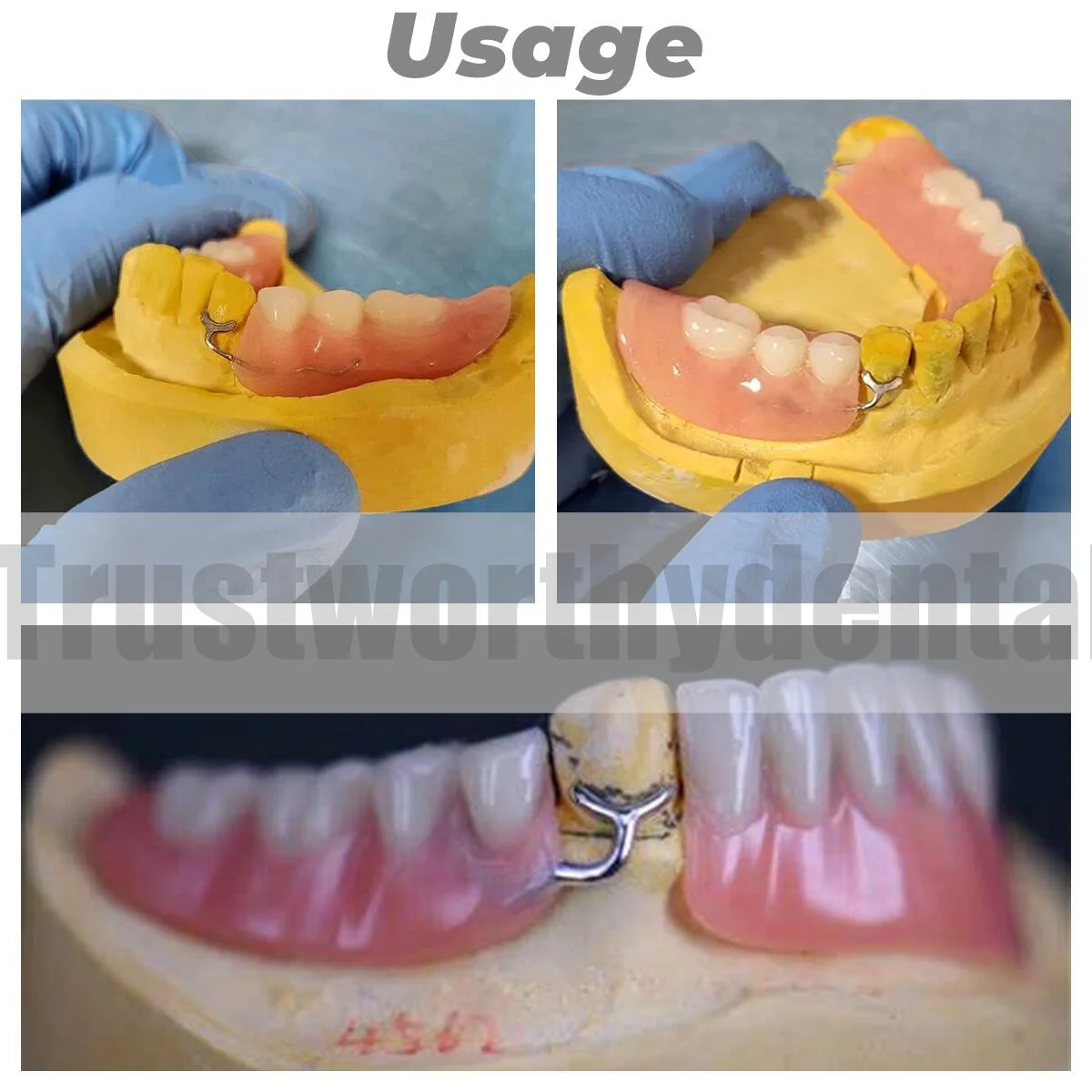 1.0mm Dental J Clasp Ball Retainer Roach Orthodontic Oblique Bar Y-Type Denture ScheuTeeth Position Hold thumbnail 2