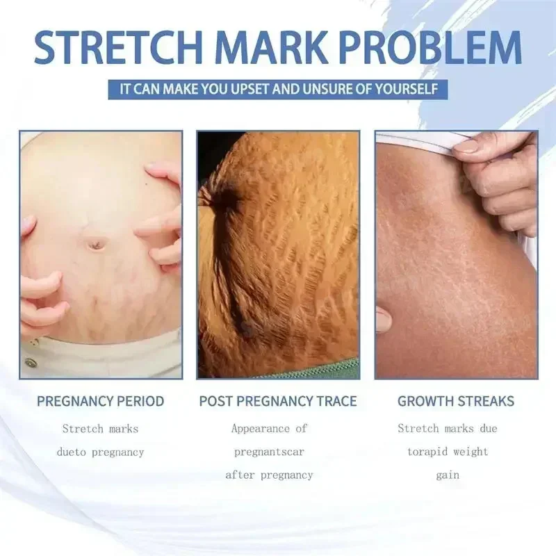 Stretch Marks Removal Cream Light Lines Postpartum Obesity Pregnancy Powerful Fast Absorption thumbnail 2