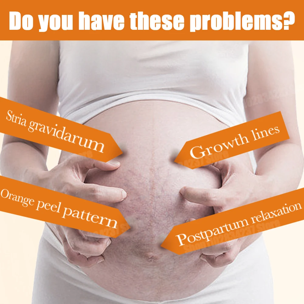 Stretch Marks Removal Cream Light Lines Postpartum Obesity Pregnancy Powerful Fast Absorption thumbnail 3
