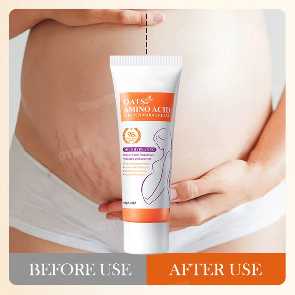 Stretch Marks Removal Cream Light Lines Postpartum Obesity Pregnancy Powerful Fast Absorption thumbnail 5