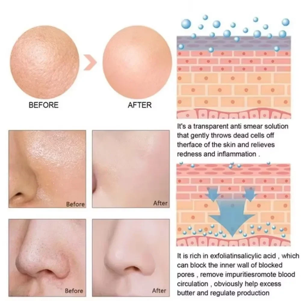 Lactic Acid Large Pores Removal Serum Pore Shrinking Minimizing Essence Moisturizing Firming Smooth Repair Korean Skin Care thumbnail 6