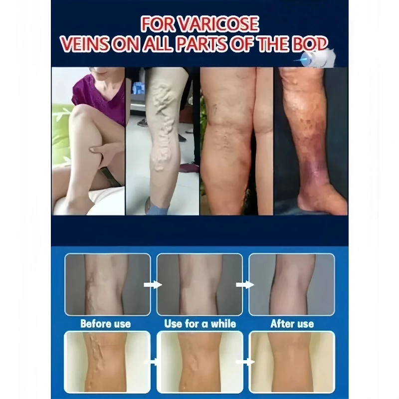 Blue Light Laser Vein Therapy | At-Home Treatment for Spider Veins & Swelling | Safe for Couperose Skin thumbnail 2
