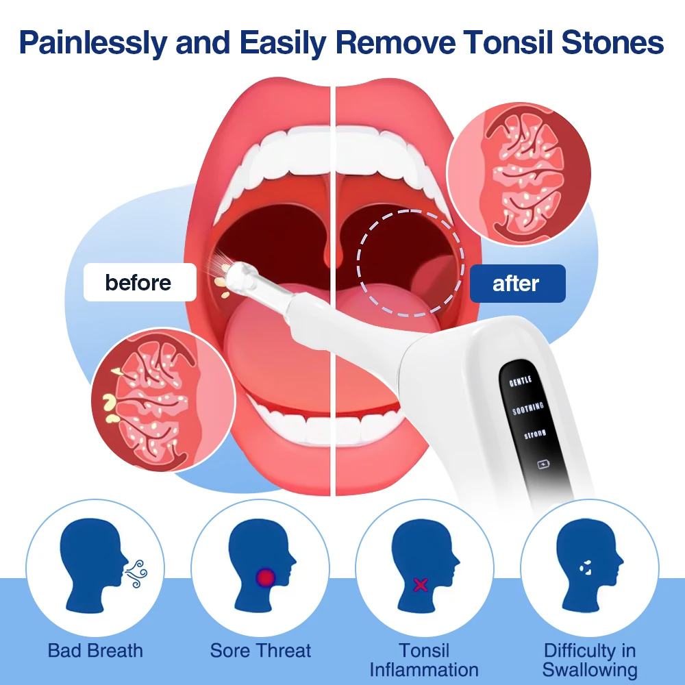 Electronic Vacuum Tonsil Stone Removal Kit 4 in 1 Mouth Vacuum Oral Care Mouth Cleaner Dental Cleaning LED Light Oral Care thumbnail 2