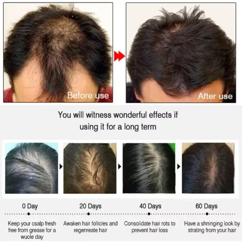 Hair Growth Serum 7 Days Fast Regrowth Essential Capsule Anti Hair loss Baldness Repair Damaged Scalp Treatment For Women Men thumbnail 4