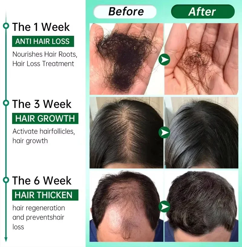 Hair Growth Serum 7 Days Fast Regrowth Essential Capsule Anti Hair loss Baldness Repair Damaged Scalp Treatment For Women Men thumbnail 6