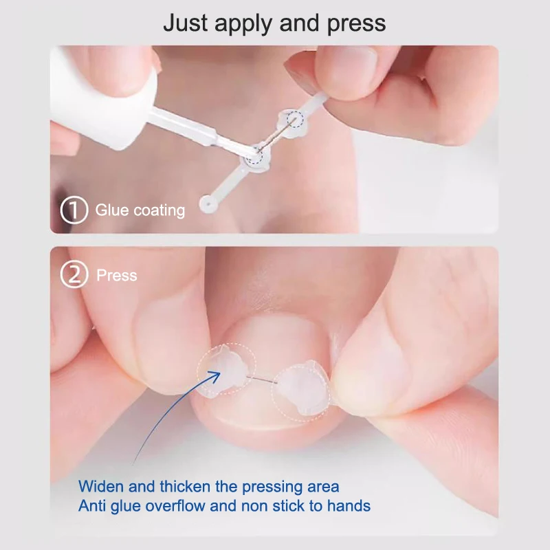 Ingrown Toenail Corrector 12/14/16/18mm Ingrown Toe Nail Treatment Elastic Patch Sticker Straightening Clip Brace Pedicure Tool thumbnail 4