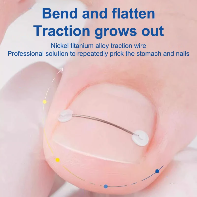 Ingrown Toenail Corrector 12/14/16/18mm Ingrown Toe Nail Treatment Elastic Patch Sticker Straightening Clip Brace Pedicure Tool thumbnail 3