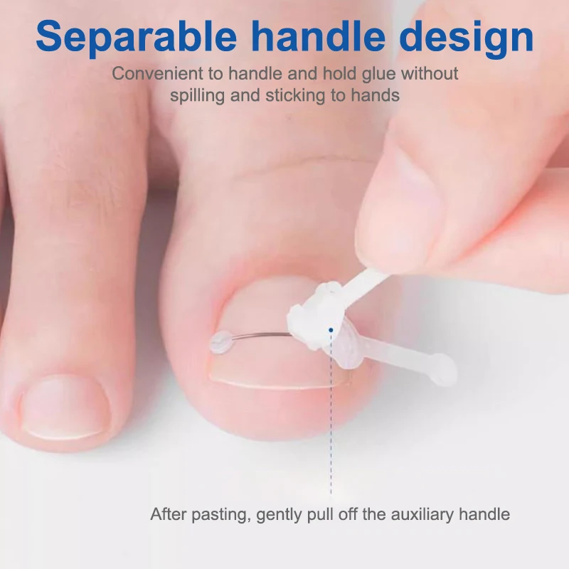 Ingrown Toenail Corrector 12/14/16/18mm Ingrown Toe Nail Treatment Elastic Patch Sticker Straightening Clip Brace Pedicure Tool thumbnail 5