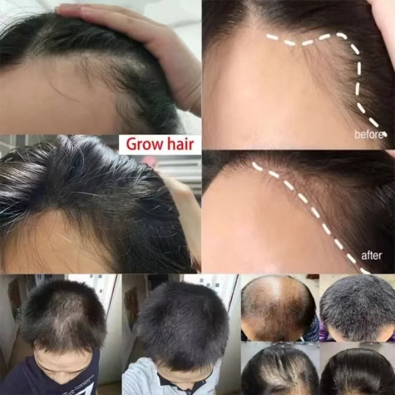 Fast Ginger Hair Growth Spray Roots Grow Anti Hair Loss Hair Regrowth Serum Scalp Damaged Repair Nourish Care Products Women Men thumbnail 4
