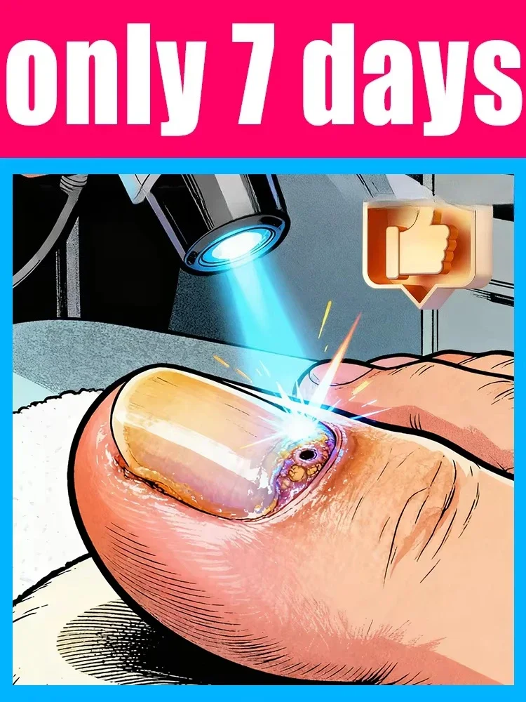 The fifth generation of champagne-colored nail laser penʜᴇʟᴘs ʏᴏᴜ sᴀʏ ɢᴏᴏᴅʙʏᴇ ᴛᴏ ᴏɴʏᴄʜᴏᴍʏᴄᴏsɪs. Tᴇᴄʜɴᴏʟᴏɢʏ ᴄʜᴀɴɢᴇs ʏᴏᴜʀ ʟɪharᴇ。