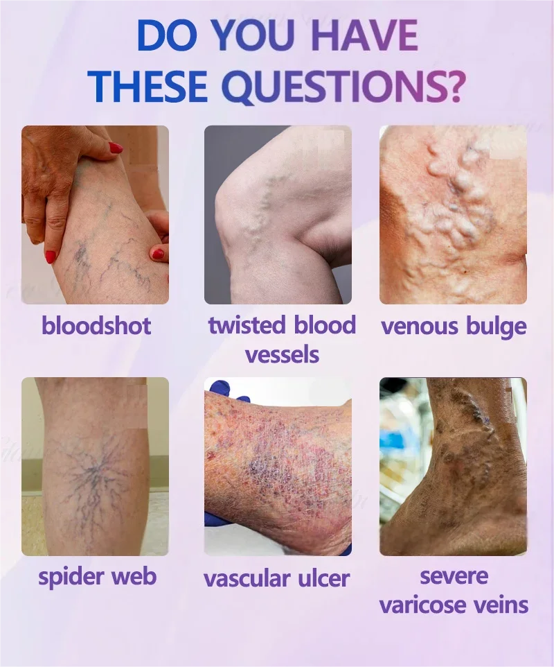 Cream For Treating Earthworm Legs ,Cream to promote blood circulation in sedentary individuals thumbnail 2