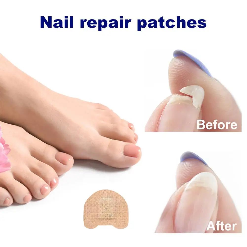 New Bags Toenail Fungus Patch Nail Repair Patches Nail Ingrown Correction Sticker Discolored Damaged Nails Foot Care Tool thumbnail 5