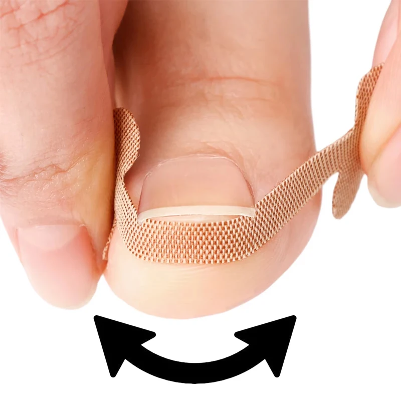 20-100pcs Adhesive Toenail Patch Ingrown Toe Nail Correction Sticker Foot Corrector Pedicure Health Care Tools Toe Treatment Pad thumbnail 4