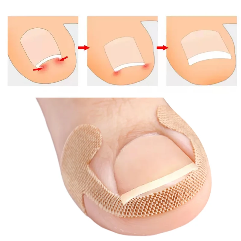 20-100pcs Adhesive Toenail Patch Ingrown Toe Nail Correction Sticker Foot Corrector Pedicure Health Care Tools Toe Treatment Pad thumbnail 3