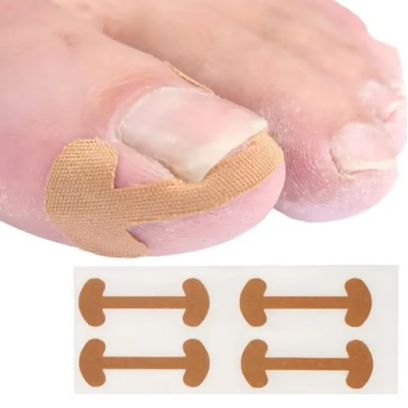 20-100pcs Adhesive Toenail Patch Ingrown Toe Nail Correction Sticker Foot Corrector Pedicure Health Care Tools Toe Treatment Pad thumbnail 5