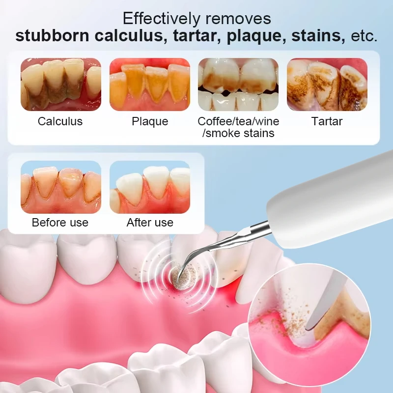 CURVY MOON T4 Electric Ultrasonic Dental Scaler Stain Removal Surface Cleaning Gum Care Tools Oral Cleaner Care thumbnail 4