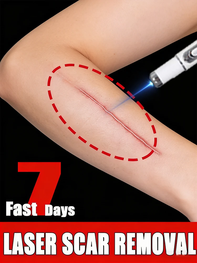 Scar removal laser product. Effective for all scars.hot