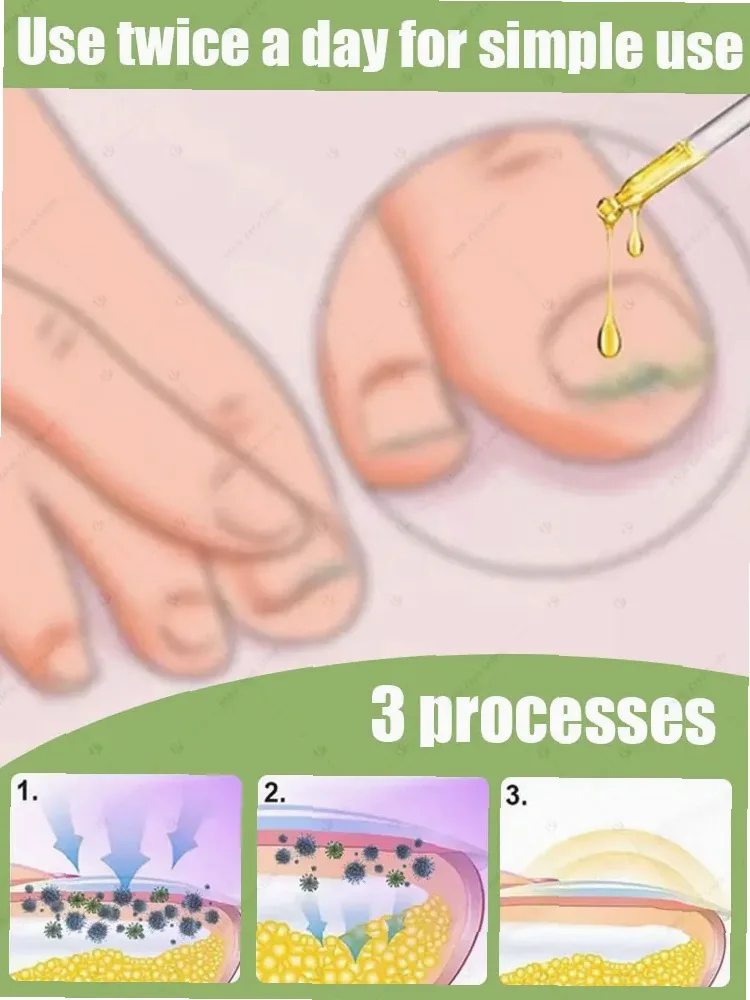 2025 Toenail Fungus Patch Waterproof Nail Repair Patches Nail Ingrown Correction Sticker Discolored Damaged Nail Foot Care Tool thumbnail 4
