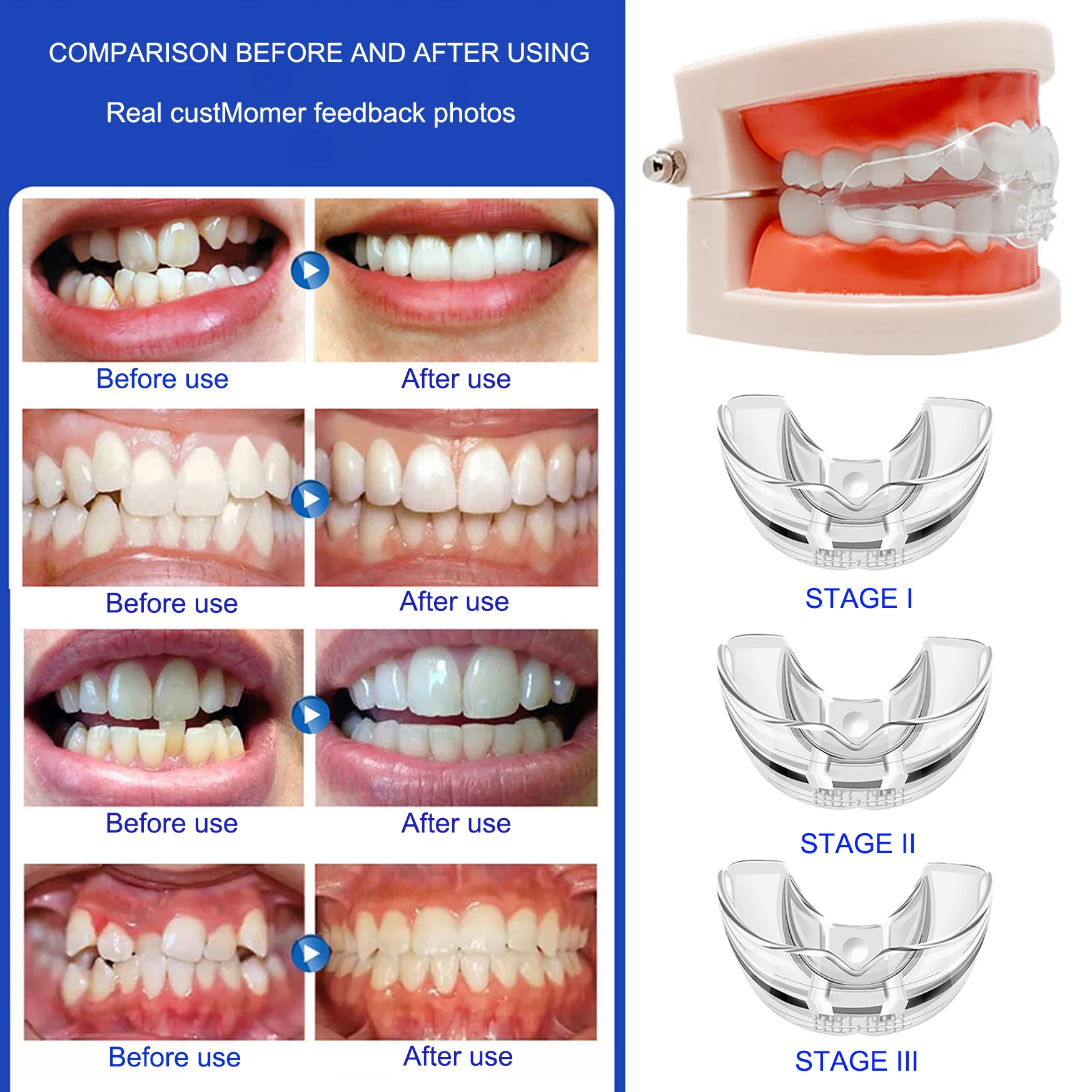 Orthodontic Braces Dental Braces Smile Teeth Alignment Trainer Instanted Silicone Teeth Retainer Mouth Guard Braces Tooth Tray thumbnail 3